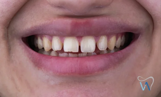 شکافها یا فضاهای کوچک بین دندانها