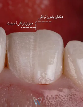 آمادهسازی دندان برای لمینت